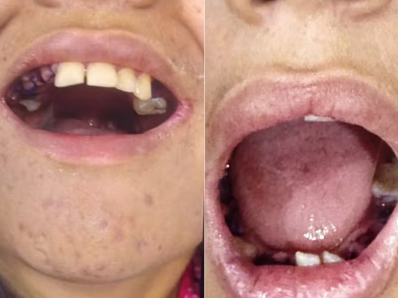 Jovem autista tem 17 dentes extraídos sem autorização da família